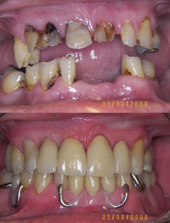 New Dentures Before And After Pictures Van WV 25206